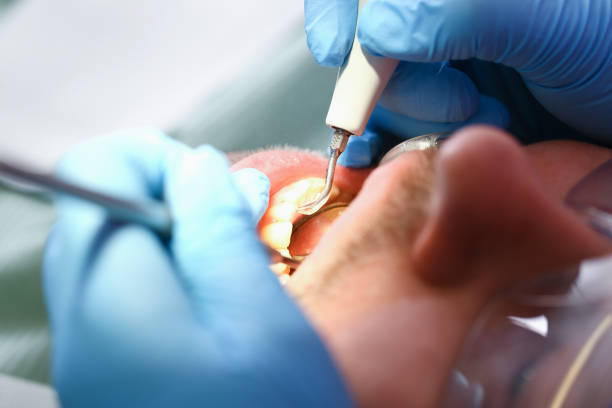 Best Emergency Tooth Extraction in Kendallville, IN